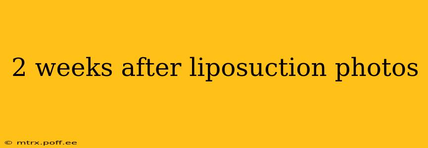 2 weeks after liposuction photos