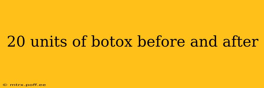 20 units of botox before and after