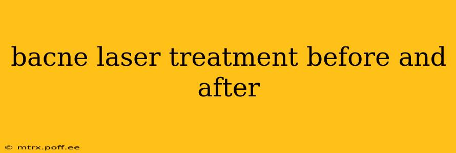 bacne laser treatment before and after