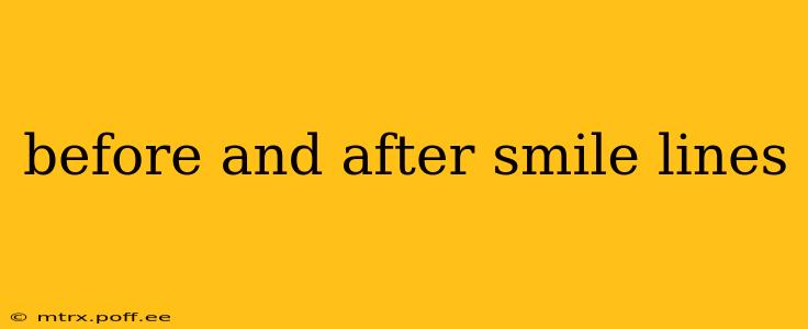 before and after smile lines