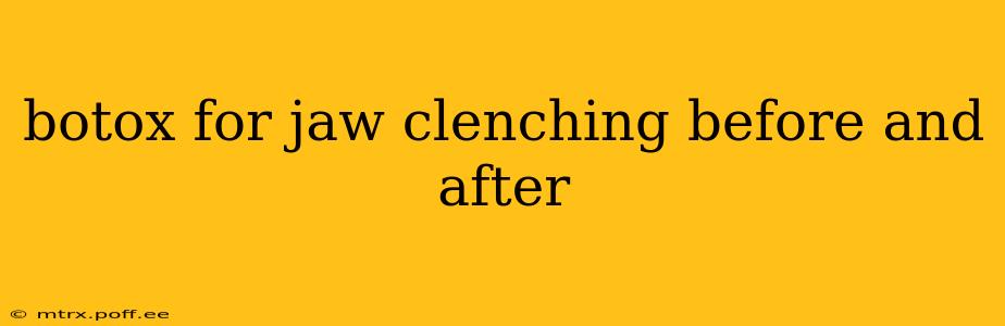 botox for jaw clenching before and after