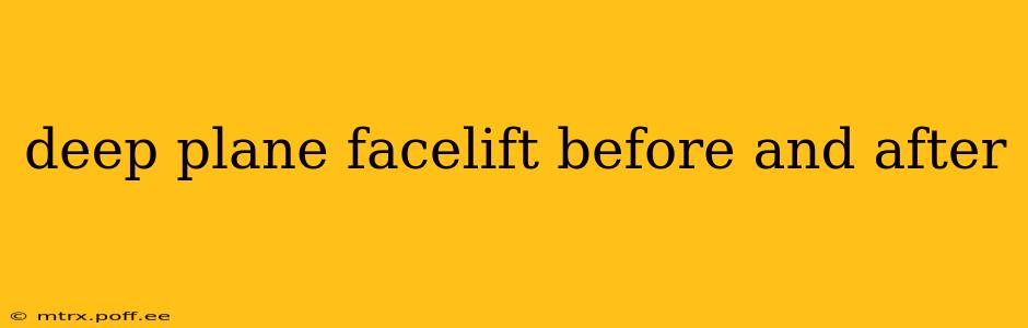 deep plane facelift before and after