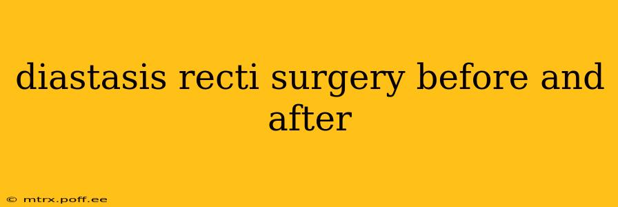 diastasis recti surgery before and after