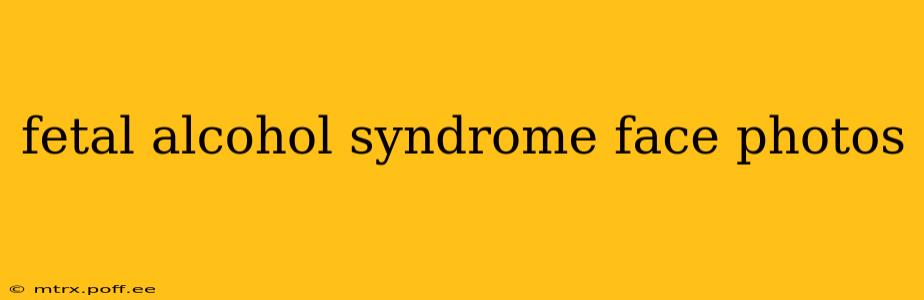 fetal alcohol syndrome face photos