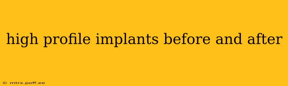 high profile implants before and after