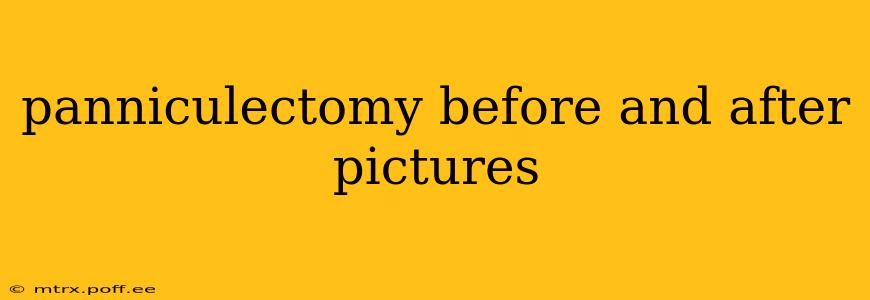 panniculectomy before and after pictures