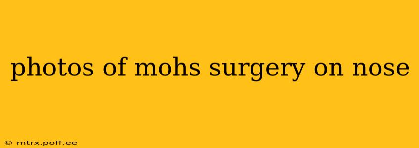 photos of mohs surgery on nose