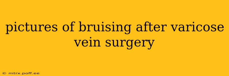pictures of bruising after varicose vein surgery