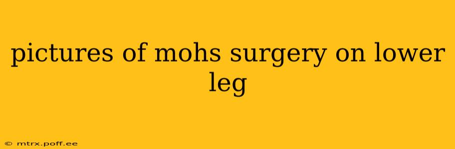 pictures of mohs surgery on lower leg
