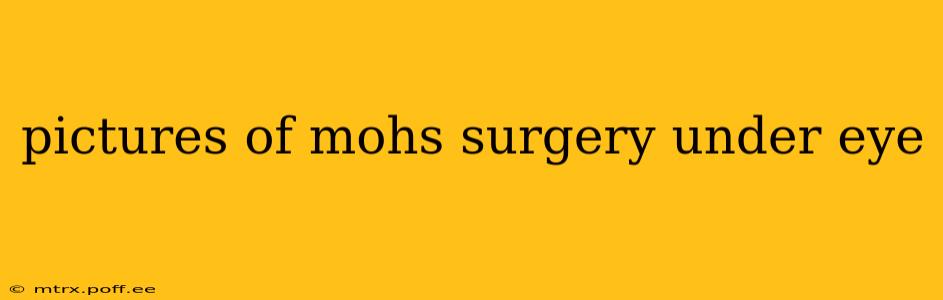 pictures of mohs surgery under eye