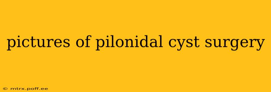 pictures of pilonidal cyst surgery