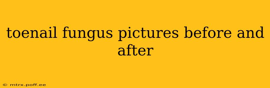 toenail fungus pictures before and after